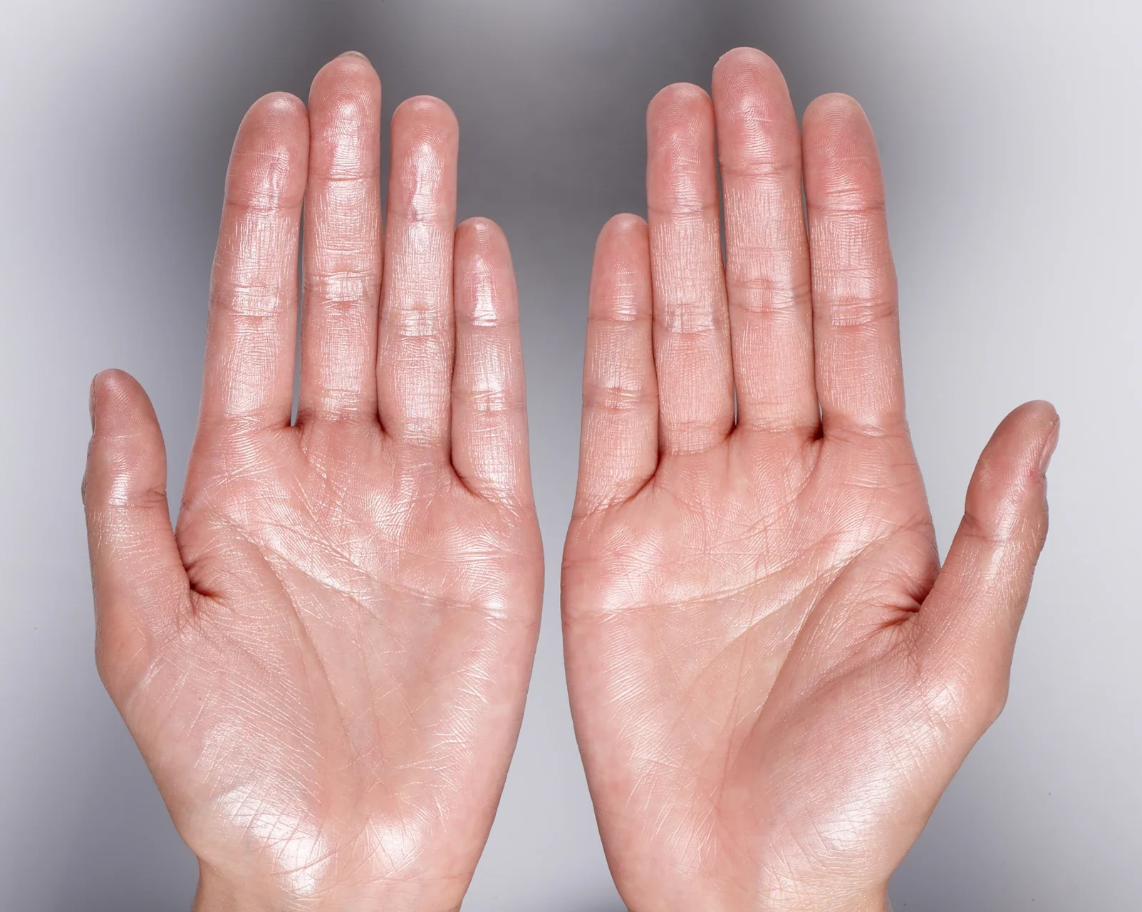 Schwitzige Hände (Hyperhidrose)
